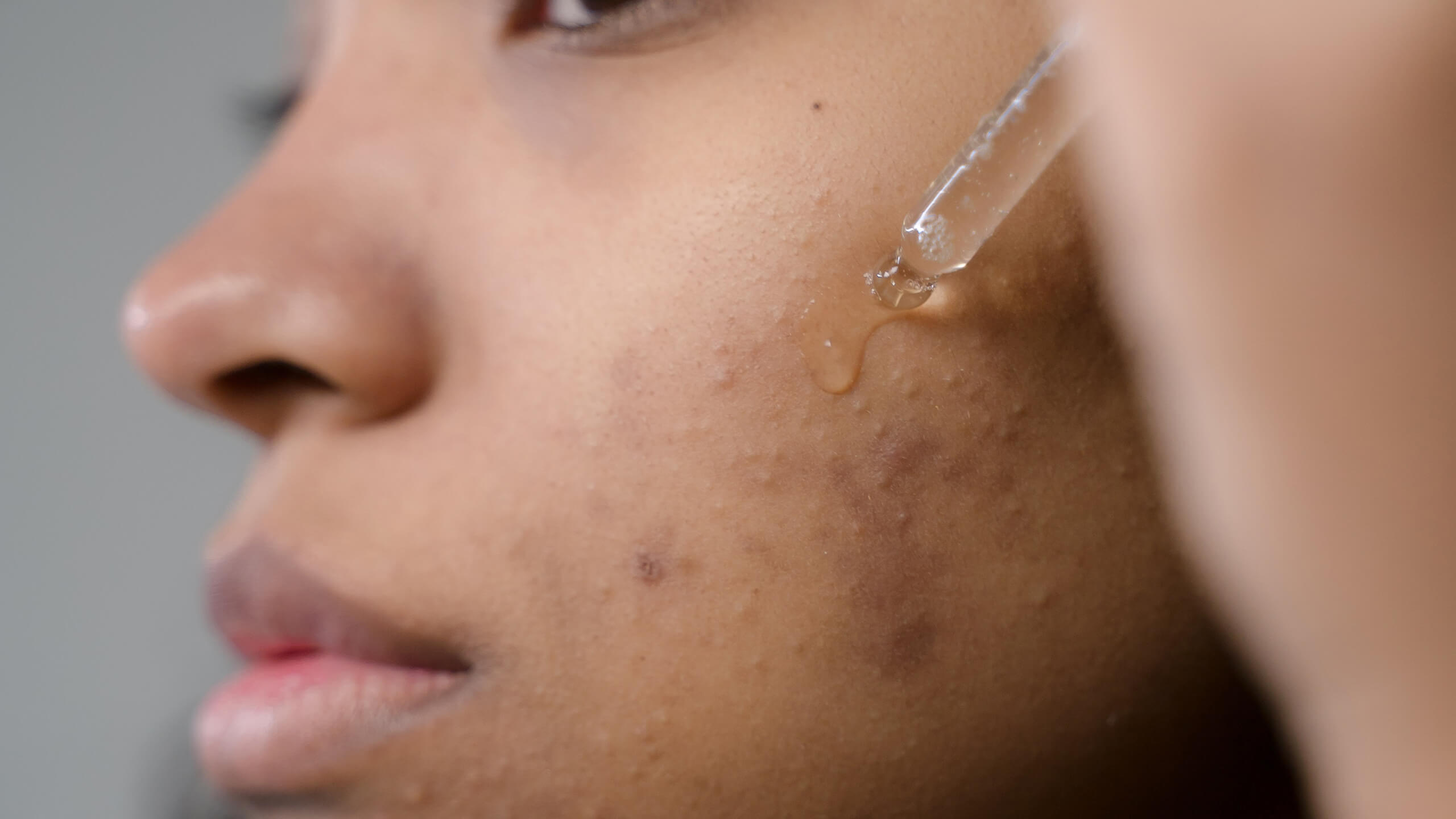 Come curare l'acne